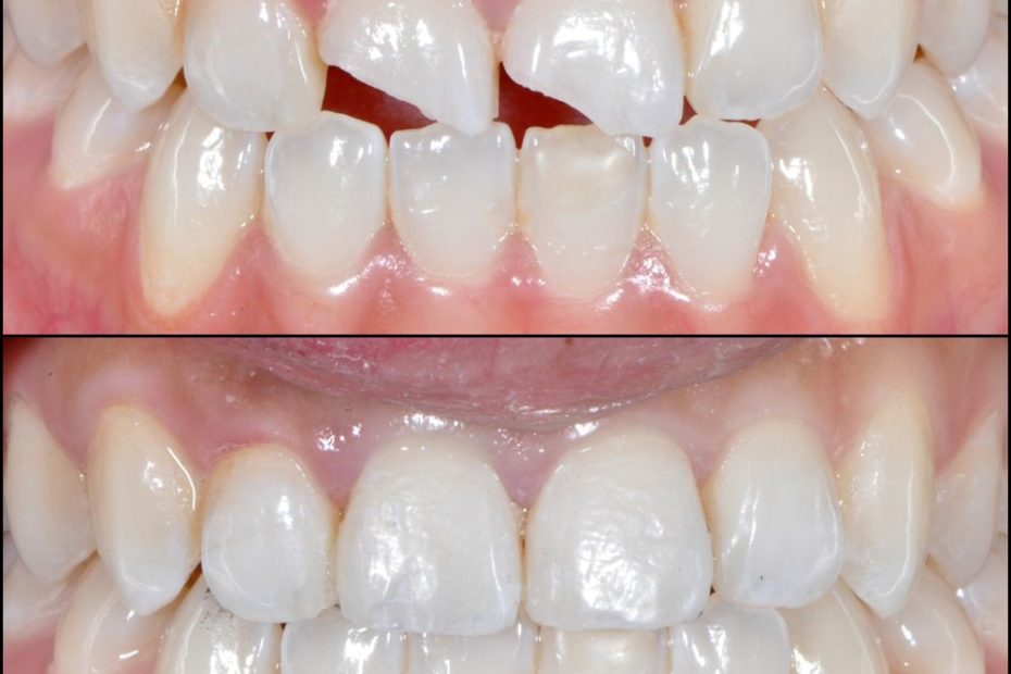 restauración con resina en fractura dental