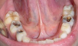 Caries avanzada