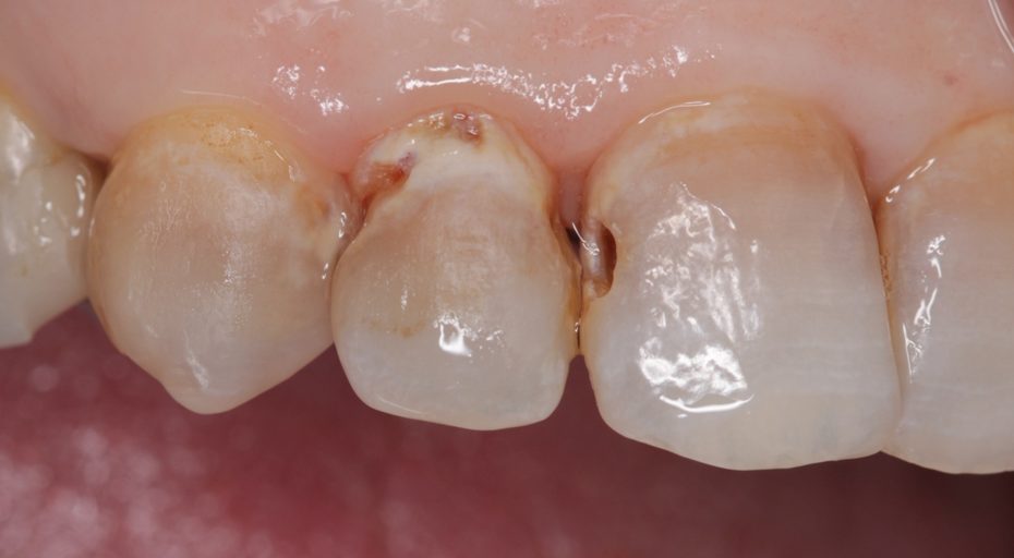 Caries cavidad incisivos