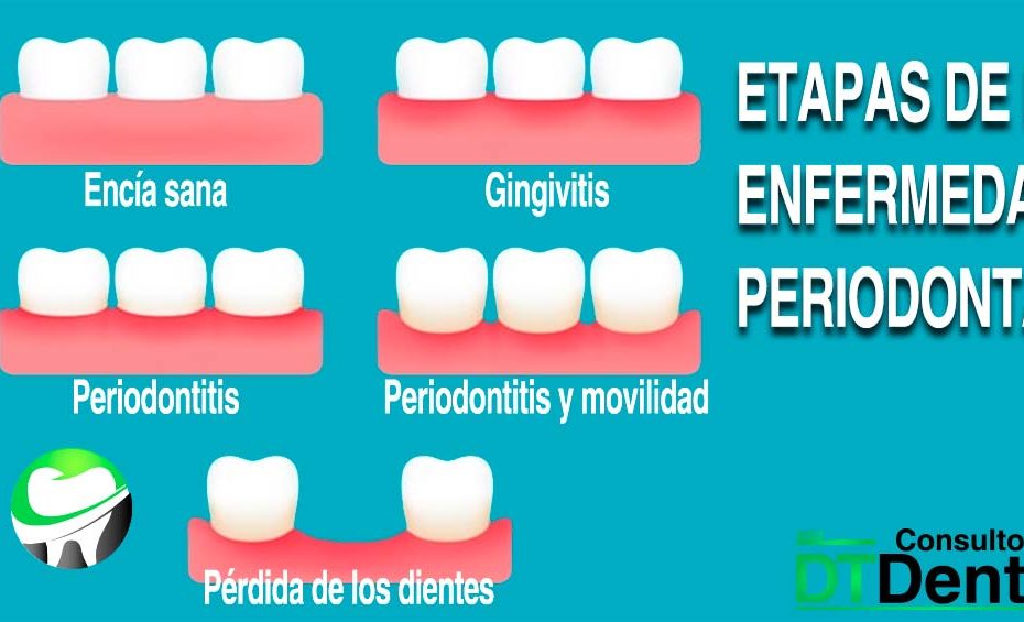 Enfermedad periodontal