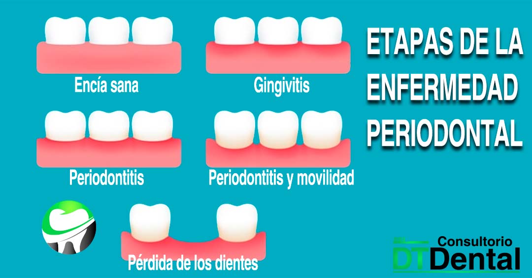 Enfermedad periodontal